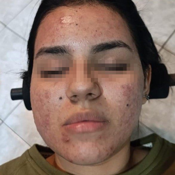 Acné, antes del tratamiento