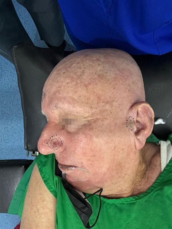 Cirugía de tumor en la nariz, antes del tratamiento