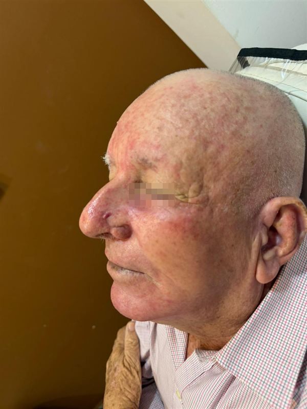 Cirugía de tumor en la nariz, después del tratamiento