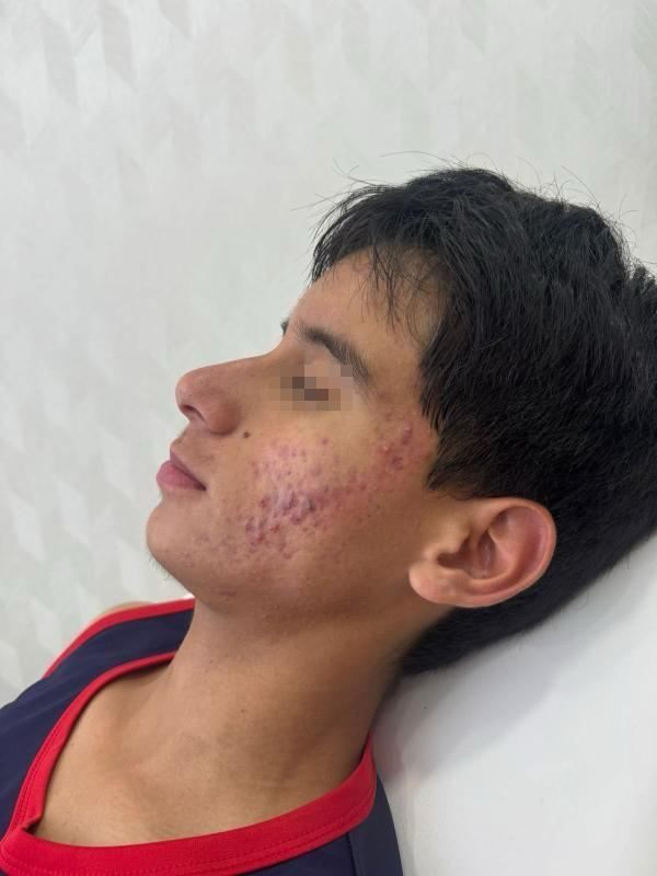 Acné juvenil, antes del tratamiento