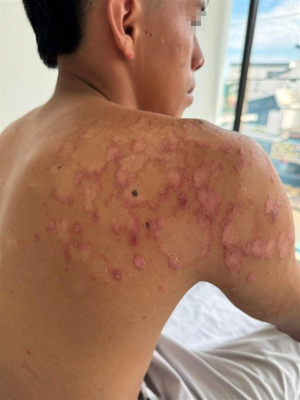 Lesiones en la espalda, antes del tratamiento