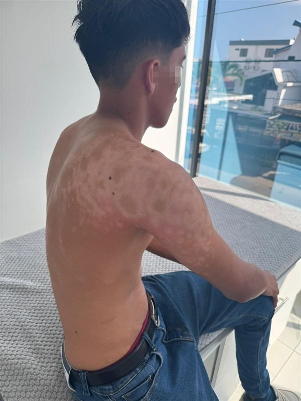 Lesiones en la espalda, después del tratamiento