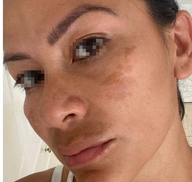 Melasma, antes del tratamiento