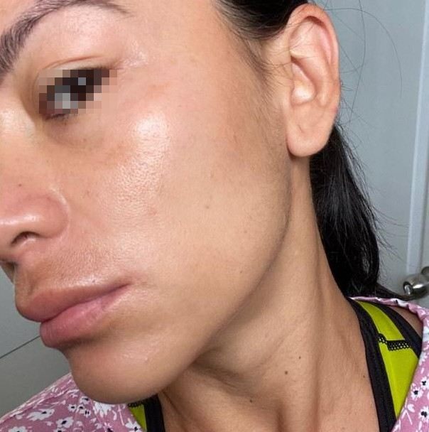 Melasma, después del tratamiento